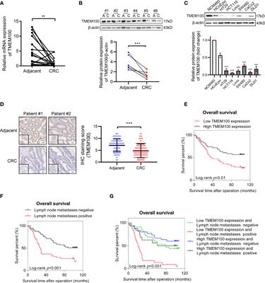 Transmembrane Protein 100 Inhibits the Progression of Colorectal Cancer by Promoting the Ubiquitin/Proteasome Degradation of HIF-1α